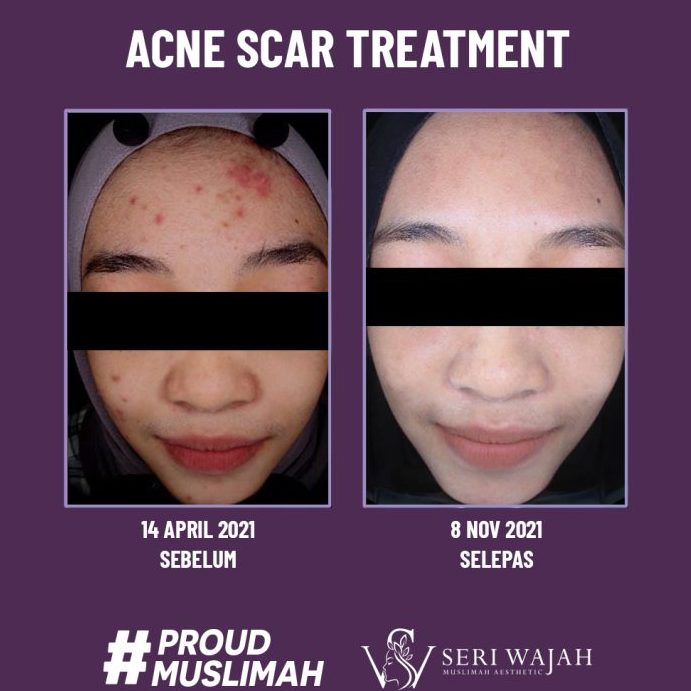 Seri Wajah Muslimah Facial Spa Pasir Gudang 1 seri wajah muslimah facial spa pasir gudang